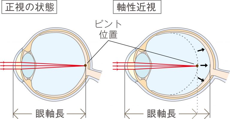 オルソケラトロジー治療とは