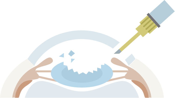 2.濁った水晶体を取り除きます