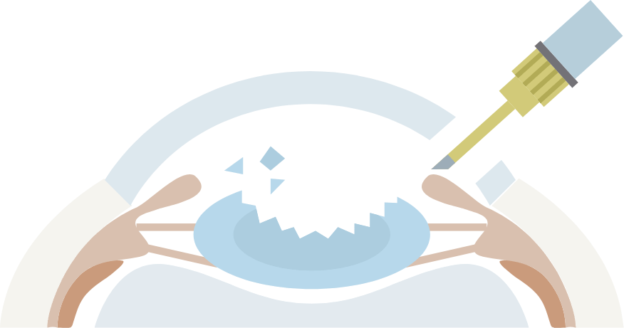 2.濁った水晶体を取り除きます
